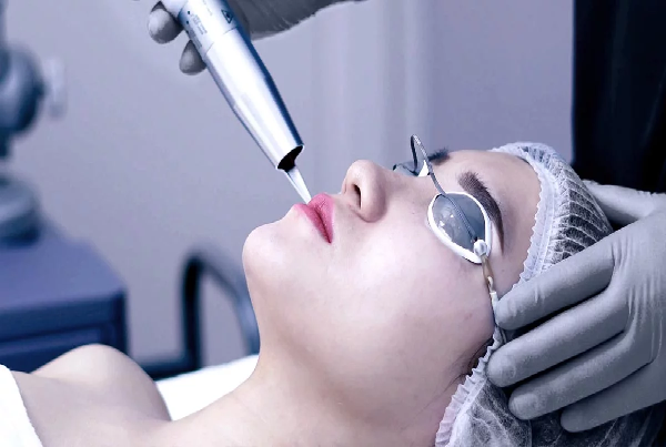 Q-Switch ND-YAG LASER
