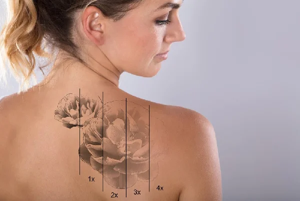 Laser Tattoo Removal