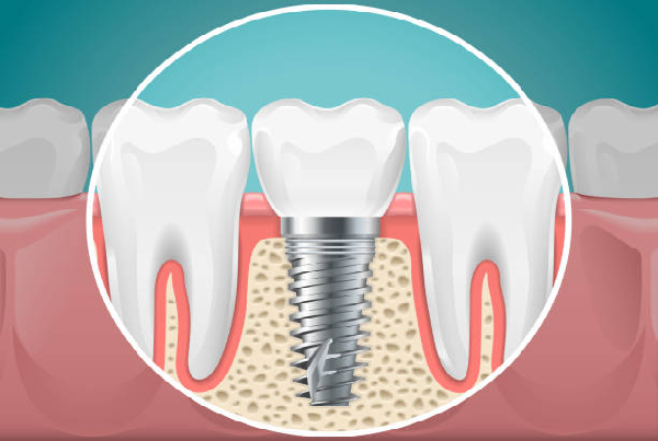 Implant Dentistry