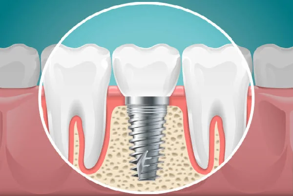 Implant Dentistry